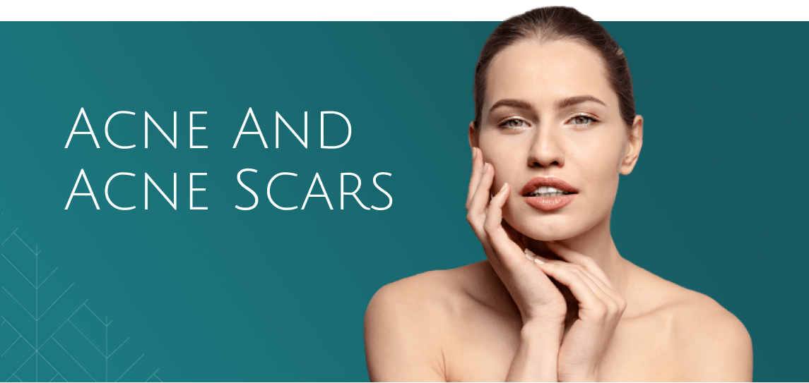 Acne and acne scars