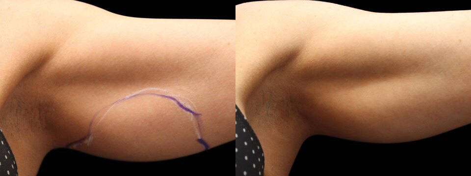 Arms Fat Reduction and Skin Tightening