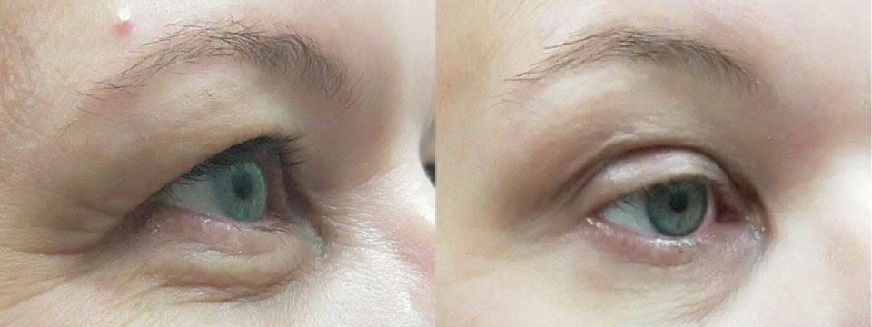Non-surgical lower blepharoplasty