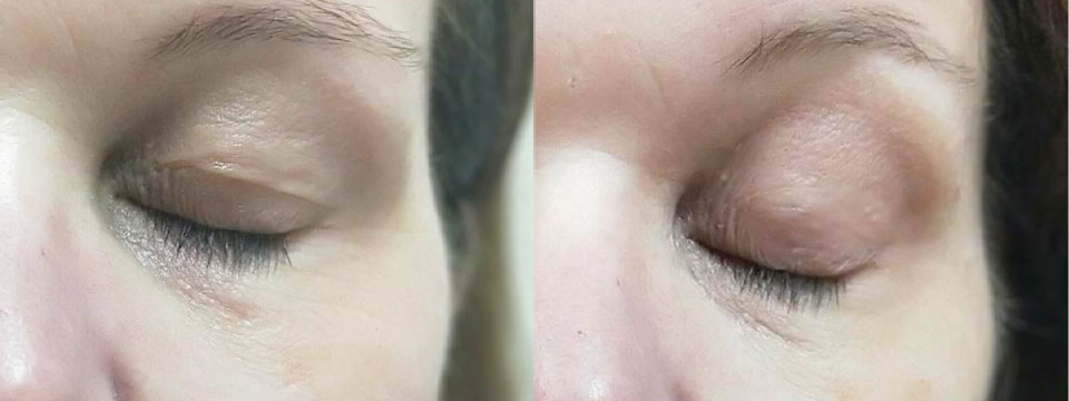 Non-surgical upper eyelid blepharoplasty