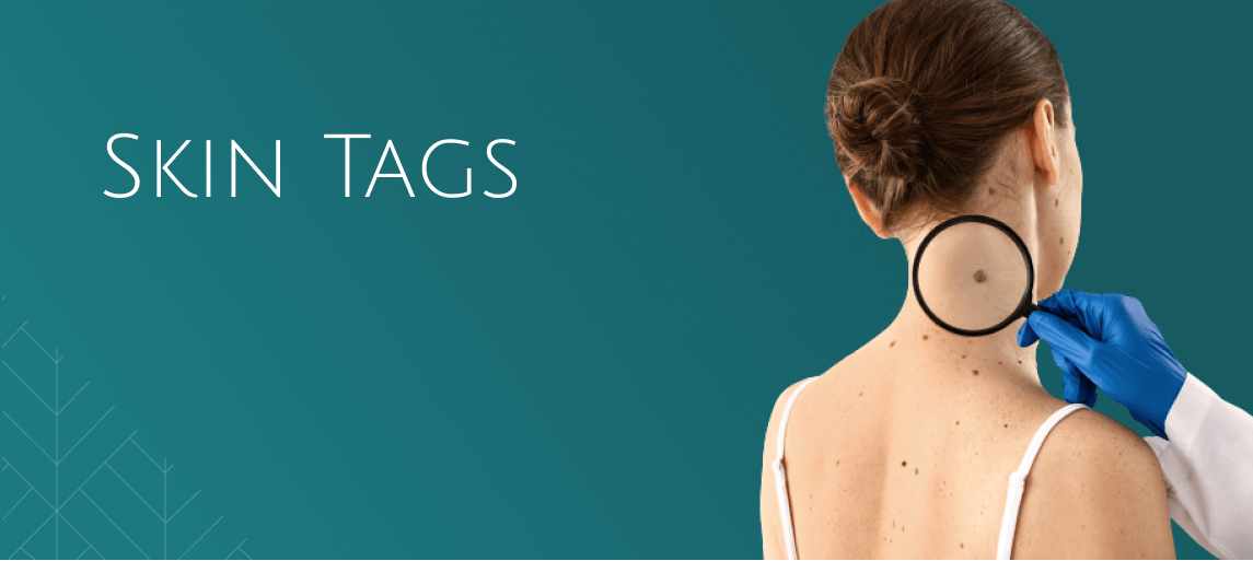 Skin tags