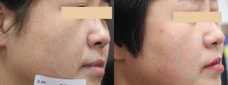 anti-wrinkle treatment