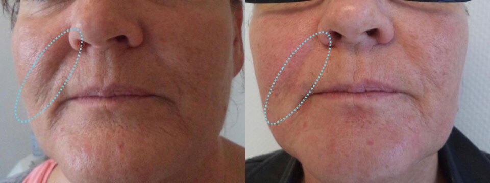 anti-wrinkle treatment