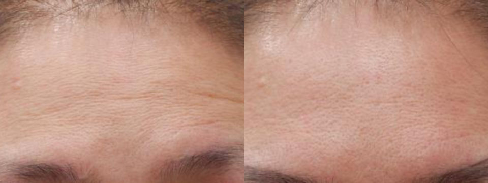anti-wrinkle treatment