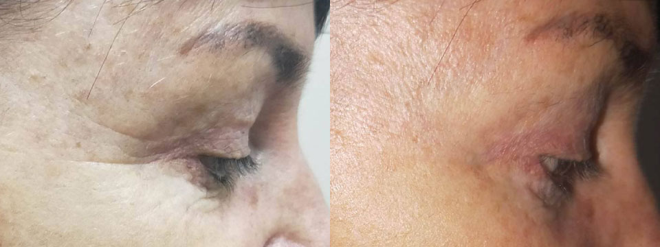 anti-wrinkle treatment