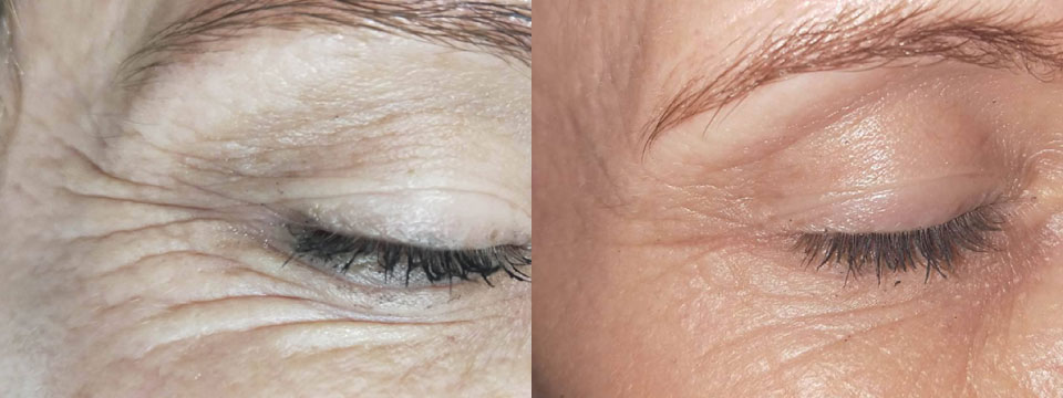 anti-wrinkle treatment