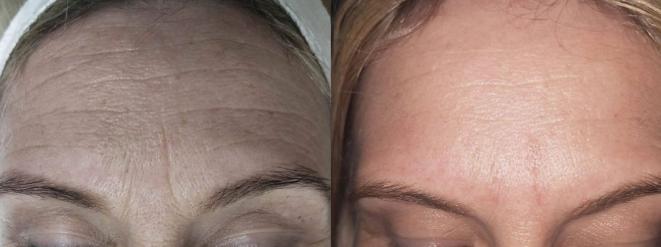 anti-wrinkle treatment