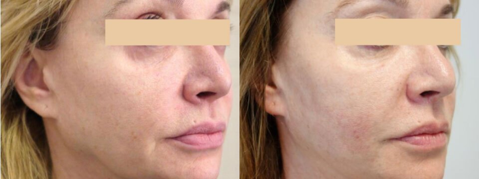 non surgical face lift