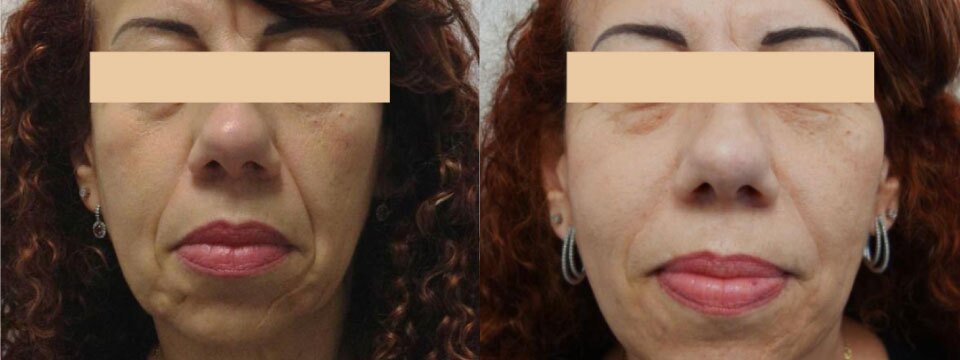 non surgical face lift