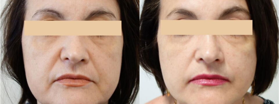 non surgical face lift