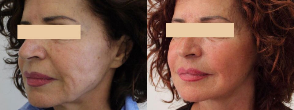 non surgical face lift