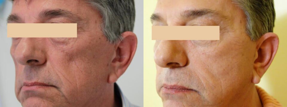 non surgical face lift