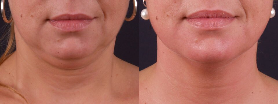 non surgical face lift