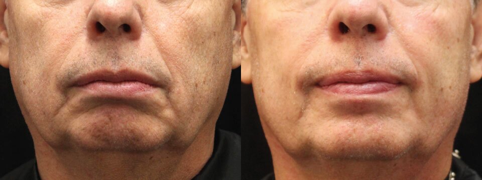 non surgical face lift