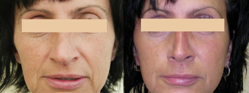 non surgical face lift