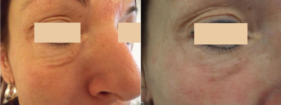 non surgical upper and lower blepharoplasty