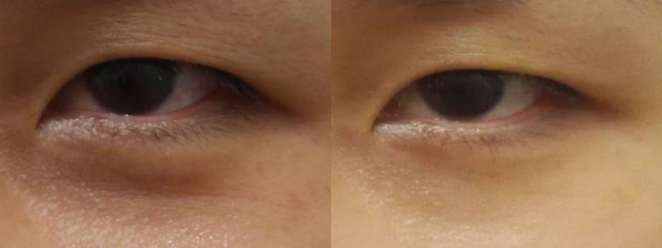 non surgical upper and lower blepharoplasty