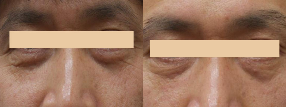 non surgical upper and lower blepharoplasty