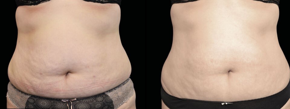 skin tightening fat reduction