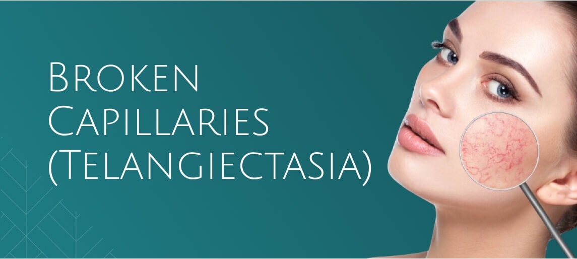 Broken capillaries Telangiectasia