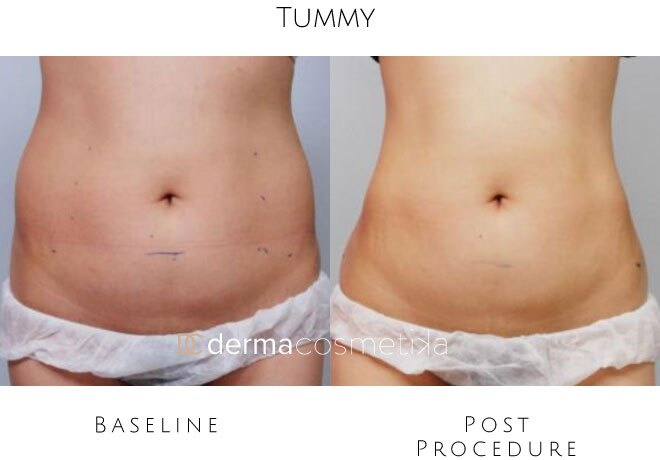 hifu tummy before after