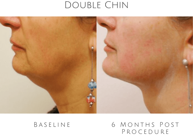 double chin before after