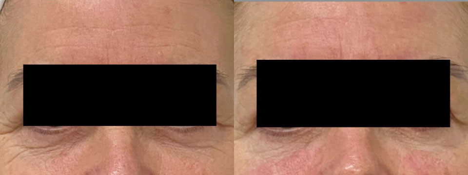 anti wrinkle treatment