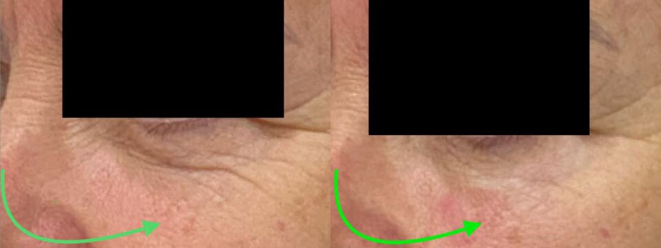 anti wrinkle treatment