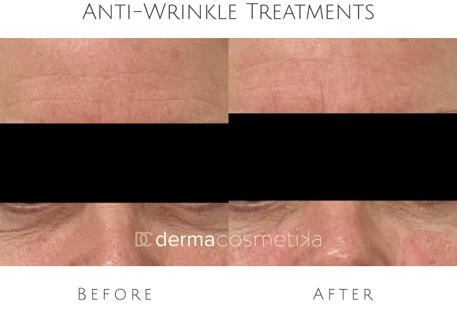 anti wrinkle treatments