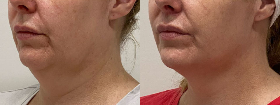 double chin reduction