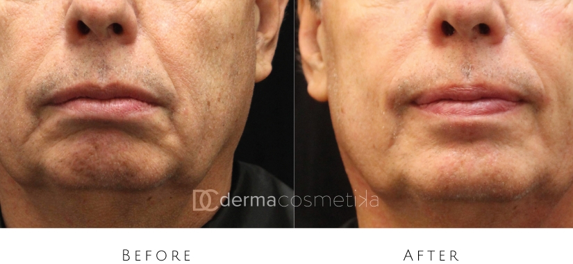 skin tightening before after