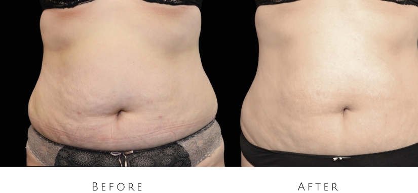 skin tightening before after