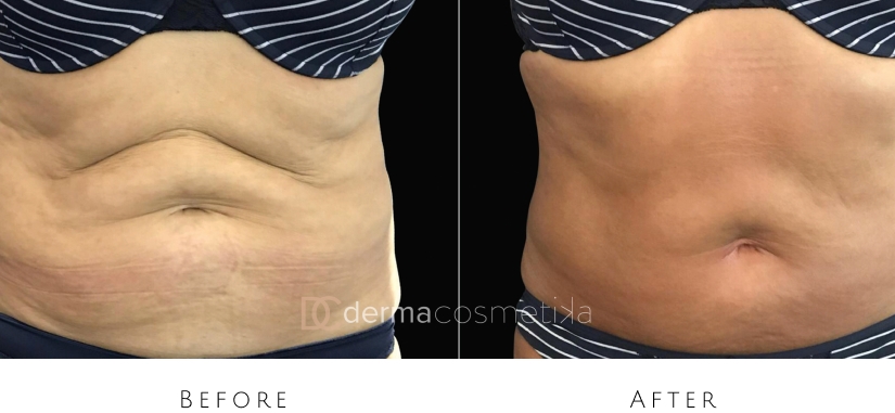 skin tightening before after