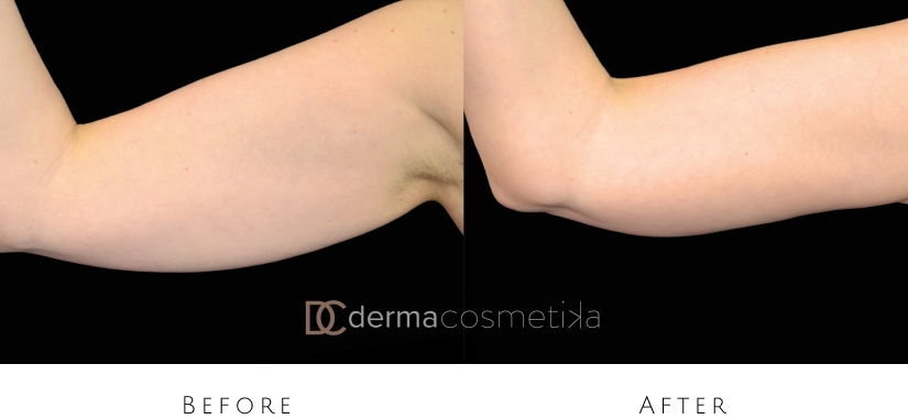 skin tightening before after