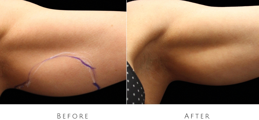 skin tightening before after