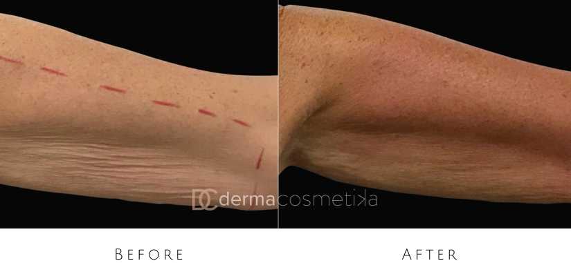 skin tightening before after