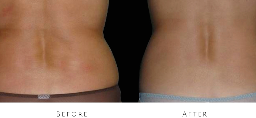 skin tightening before after