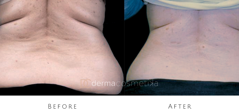 skin tightening before after