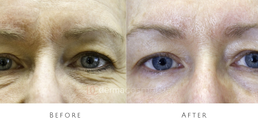 skin tightening before after