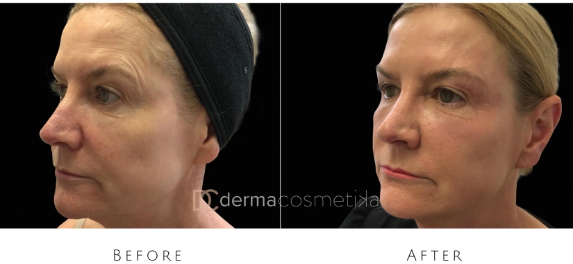skin tightening before after