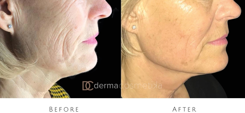 skin tightening before after