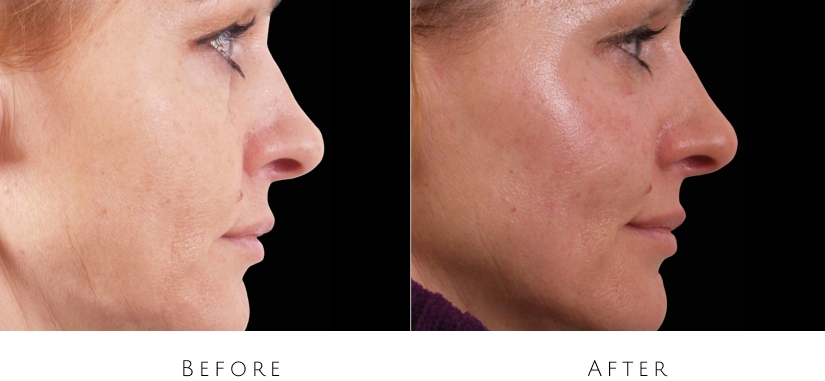 skin tightening before after