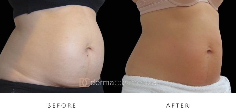 skin tightening before after