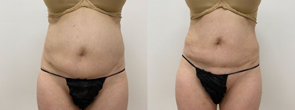 fat freezing before after