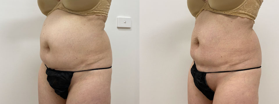 fat freezing before after