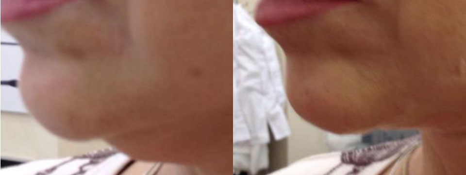 double chin