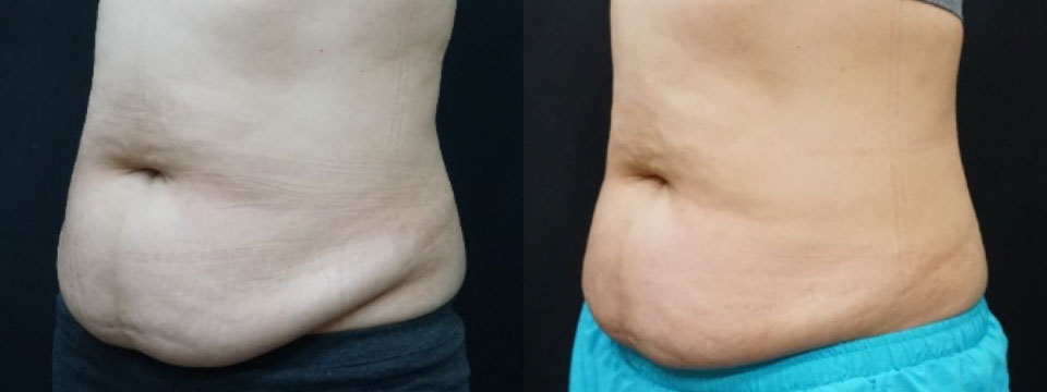 fat freezing
