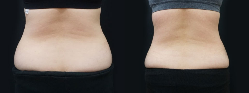 fat freezing
