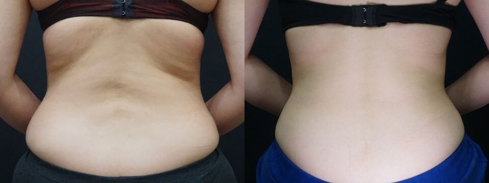 fat freezing