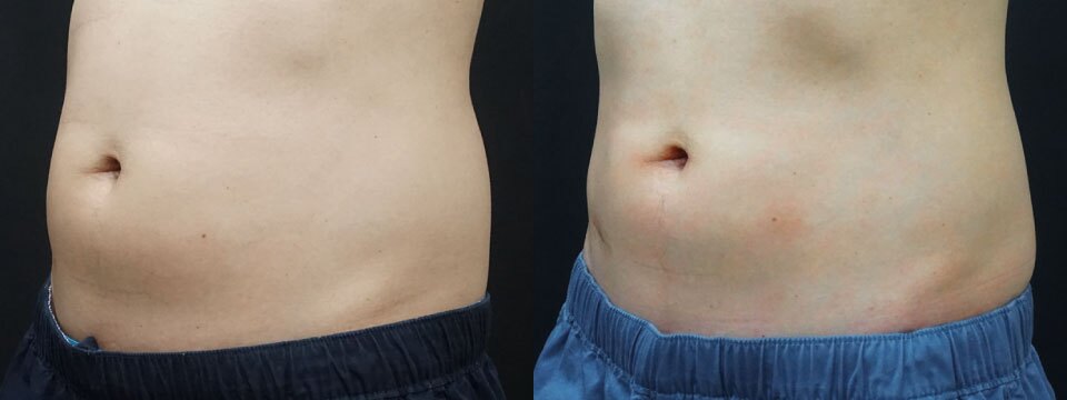 fat freezing